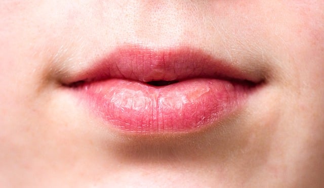 Трескаются уголки губ, какого витамина не хватает